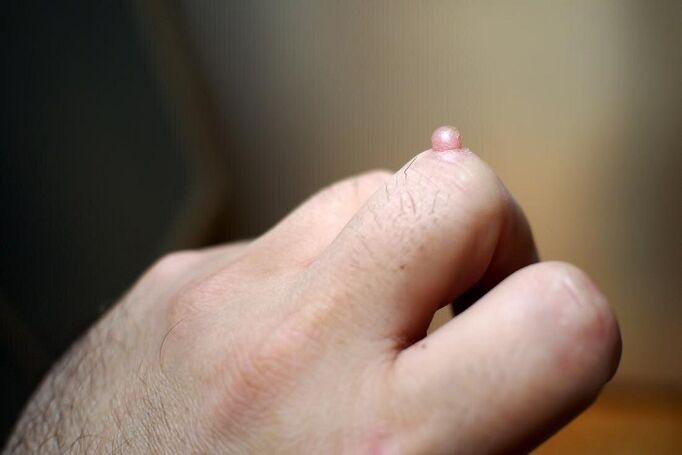 wart on the finger