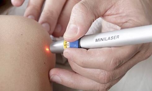 removal of papilloma by laser
