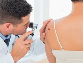 the doctor examines the papilloma about recommends removal with drugs