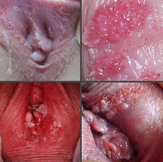 Close-up of papillomas in the vagina
