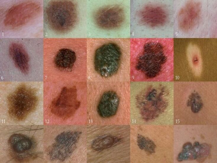 types of warts on the skin