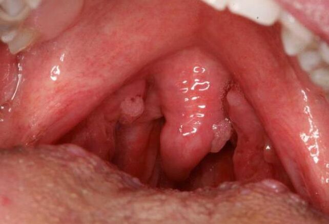 papillomas in the throat