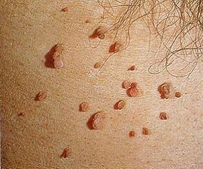 human papillomavirus on skin