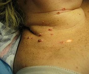 human papillomavirus on the neck