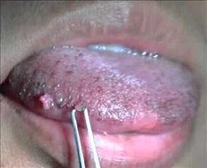 human papillomavirus on tongue