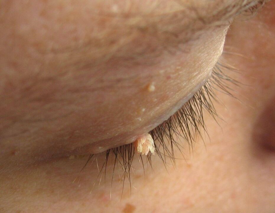 papillomas on the eyelid
