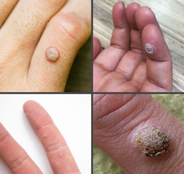 Common types of warts on the fingers