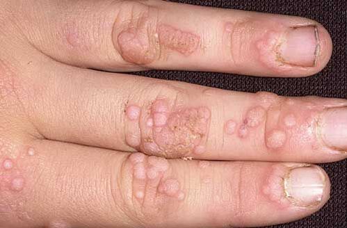 how to get rid of warts on hands