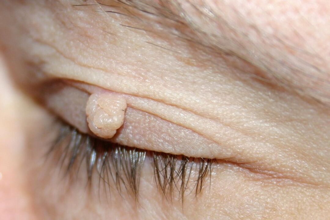 symptoms of papilloma on the eyelid