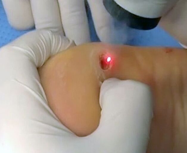 The procedure for removing warts on the heel using a laser