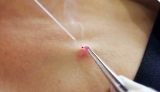 removal of papillomas on the body with a laser