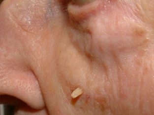 Dislocation of warts