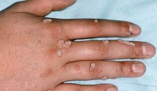 types of warts and methods for their removal
