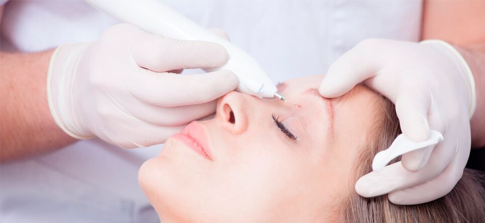 Laser facial wart removal procedure